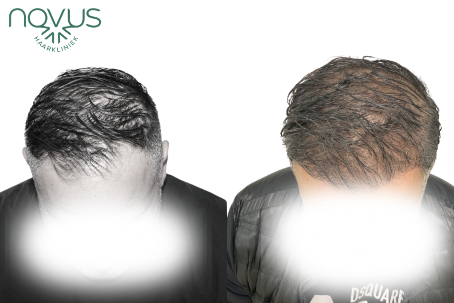 Haartransplantatie resultaat — voor en na, patiënt 1