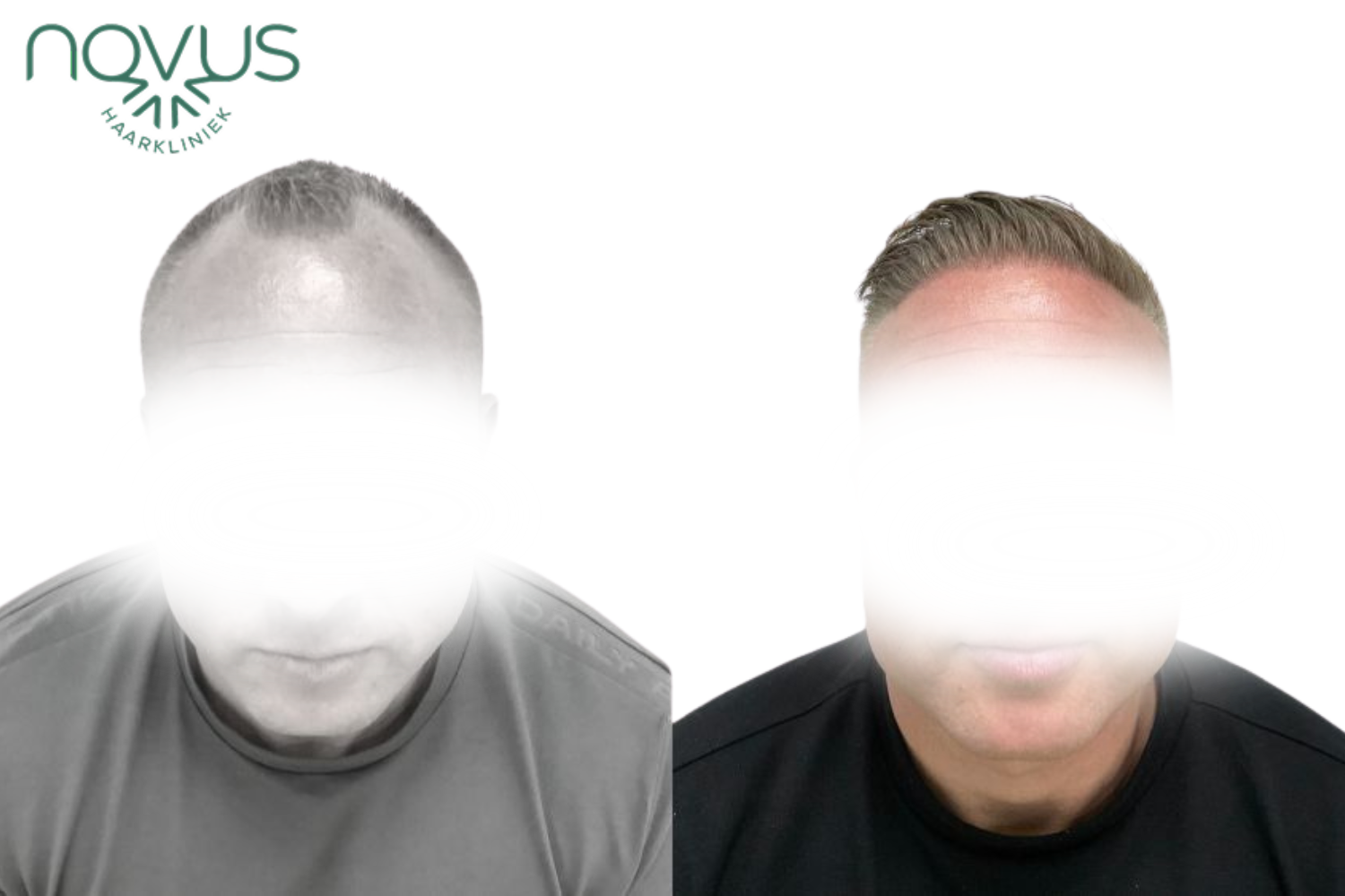 Haartransplantatie resultaat — voor en na, patiënt 3