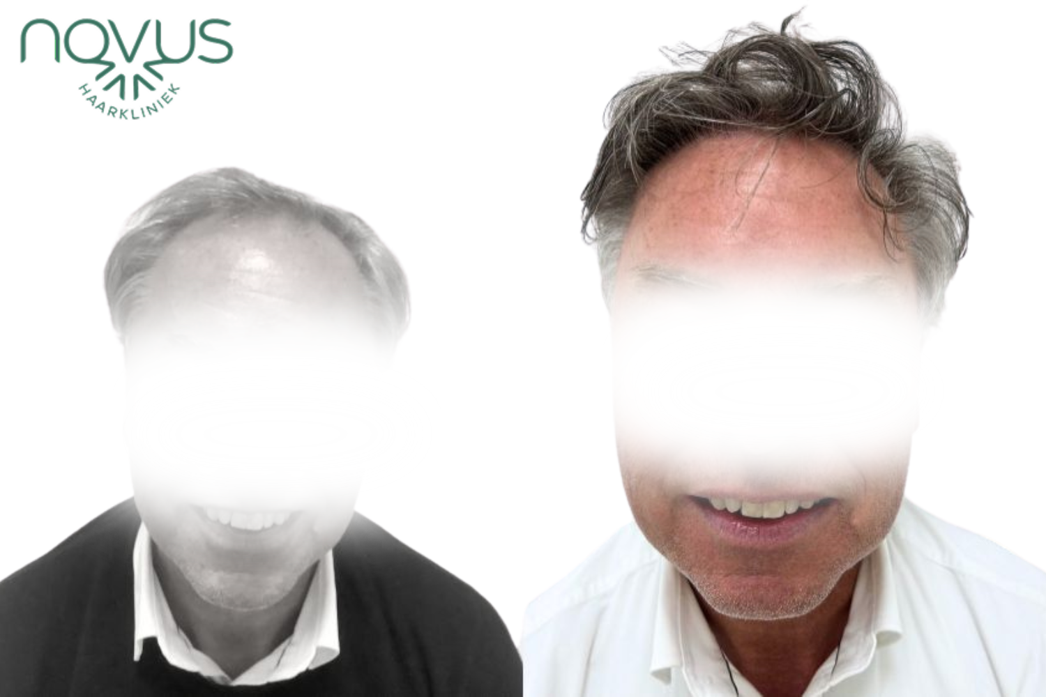 Haartransplantatie resultaat — voor en na, patiënt 4