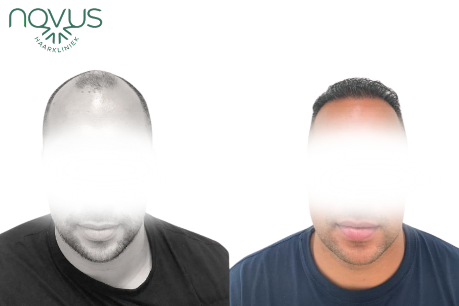 Haartransplantatie resultaat — voor en na, patiënt 5